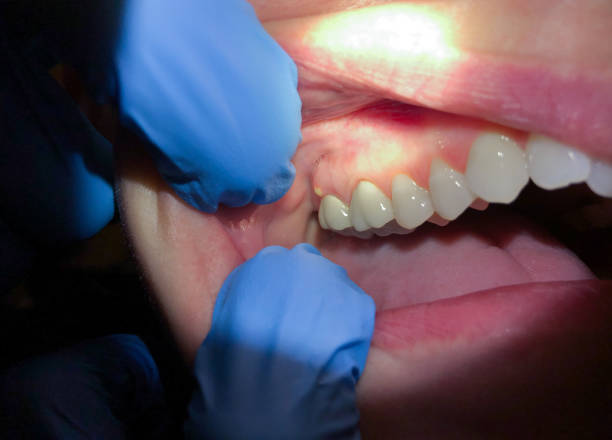 Best Chipped Tooth Repair Near Me  in Sayre, OK